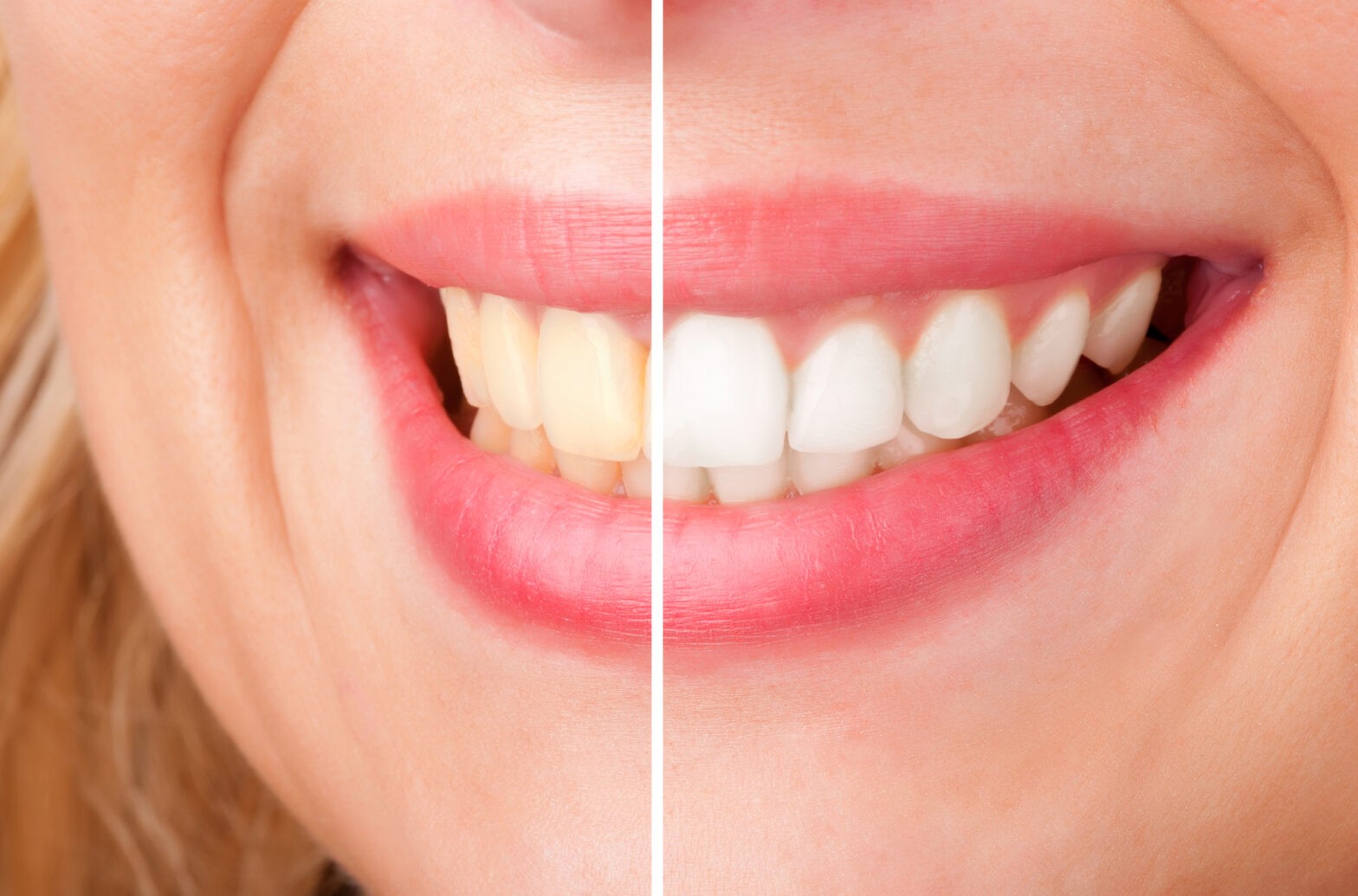 Confidence Starts with a Smile: How Teeth Whitening Can Boost Your Self-Esteem