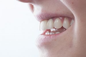 Are you wondering why veneers can be expensive? At Laguna Niguel Smiles Dentistry, we'll help you understand the cost and value of veneers for your smile.