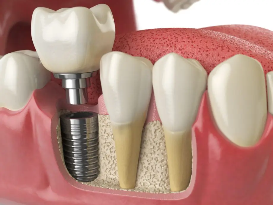 Putting A Tooth On A Dental Implant