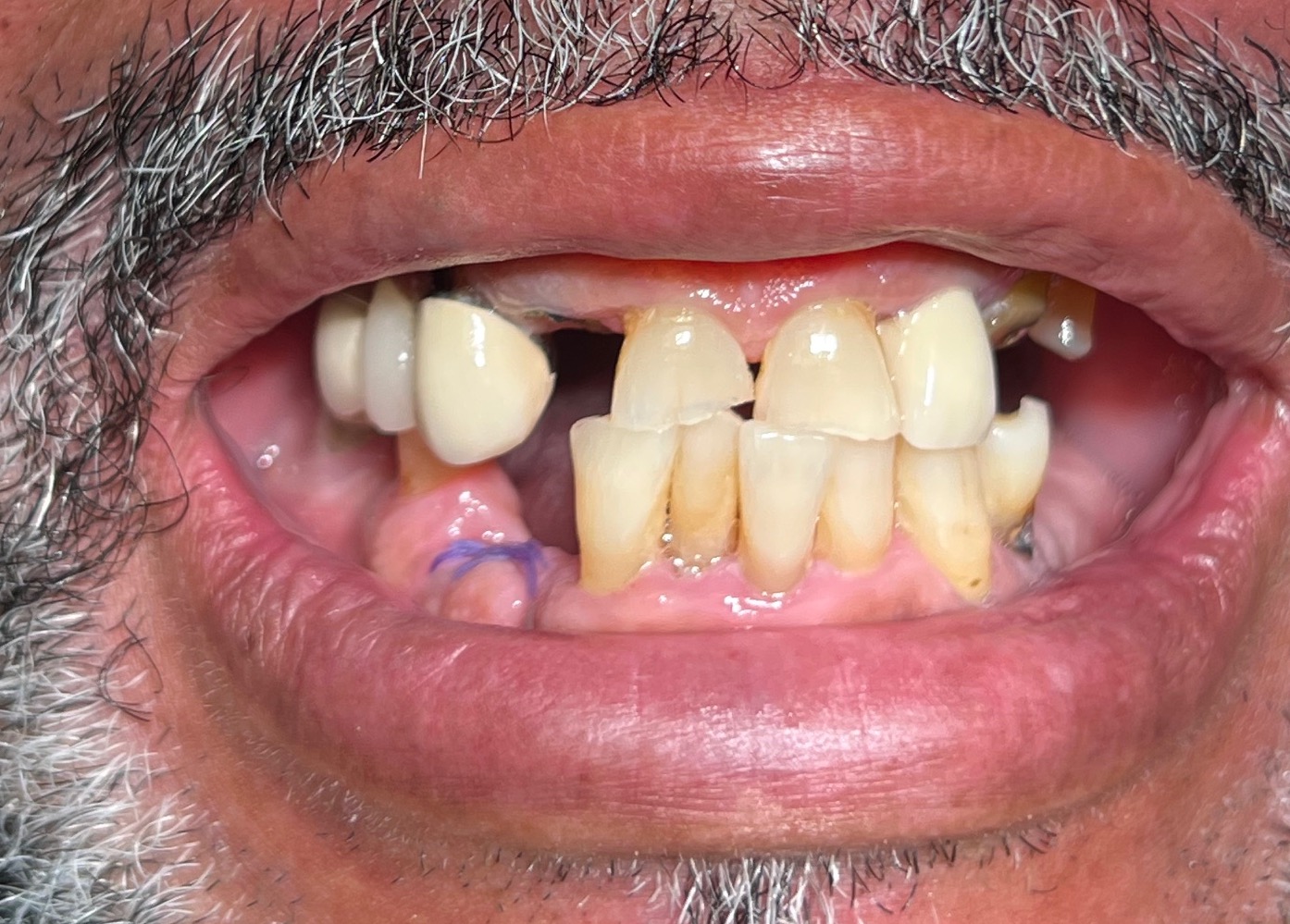 Before and After Gallery Laguna Niguel Smiles Dentistry