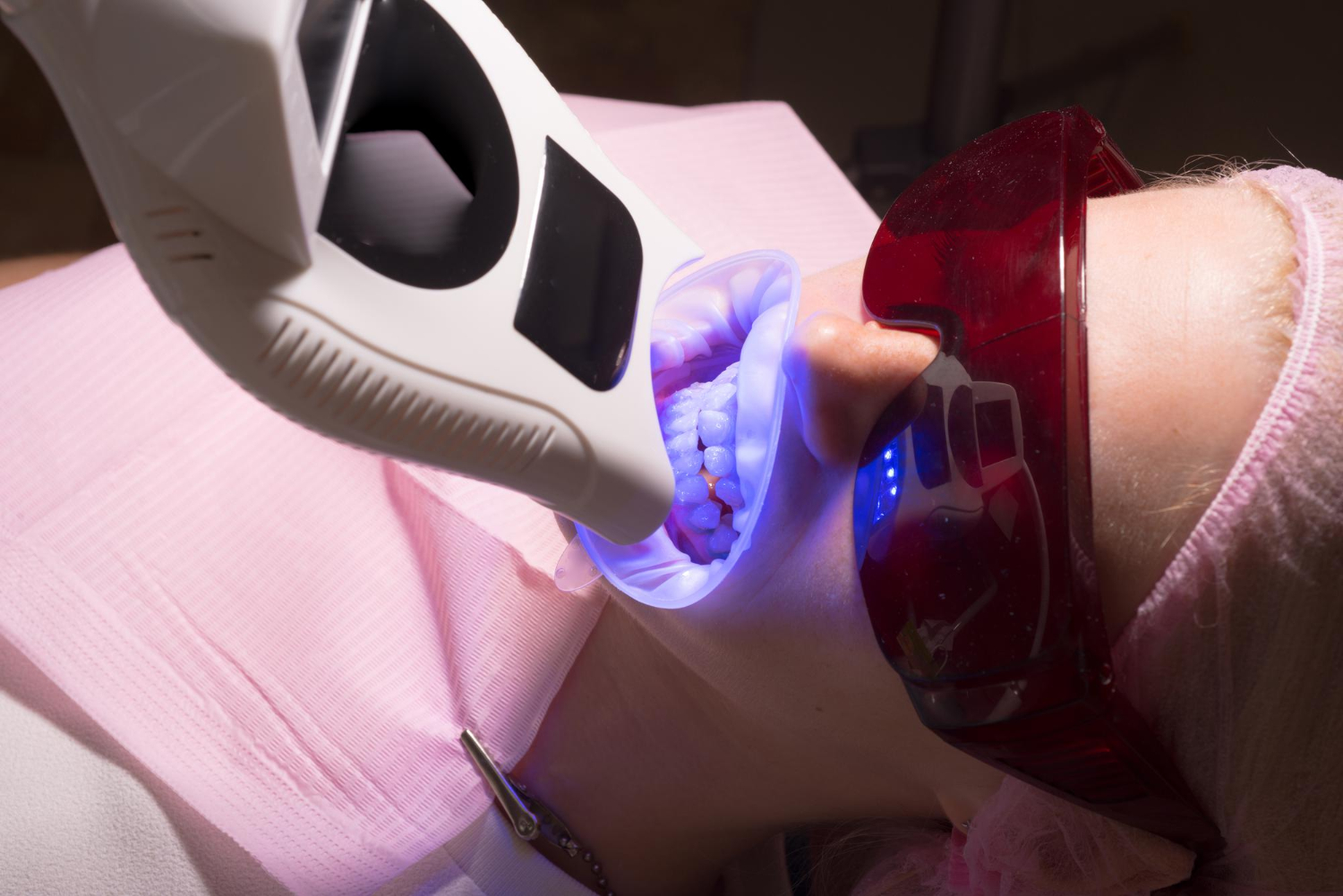 What is the difference between teeth whitening and teeth bleaching