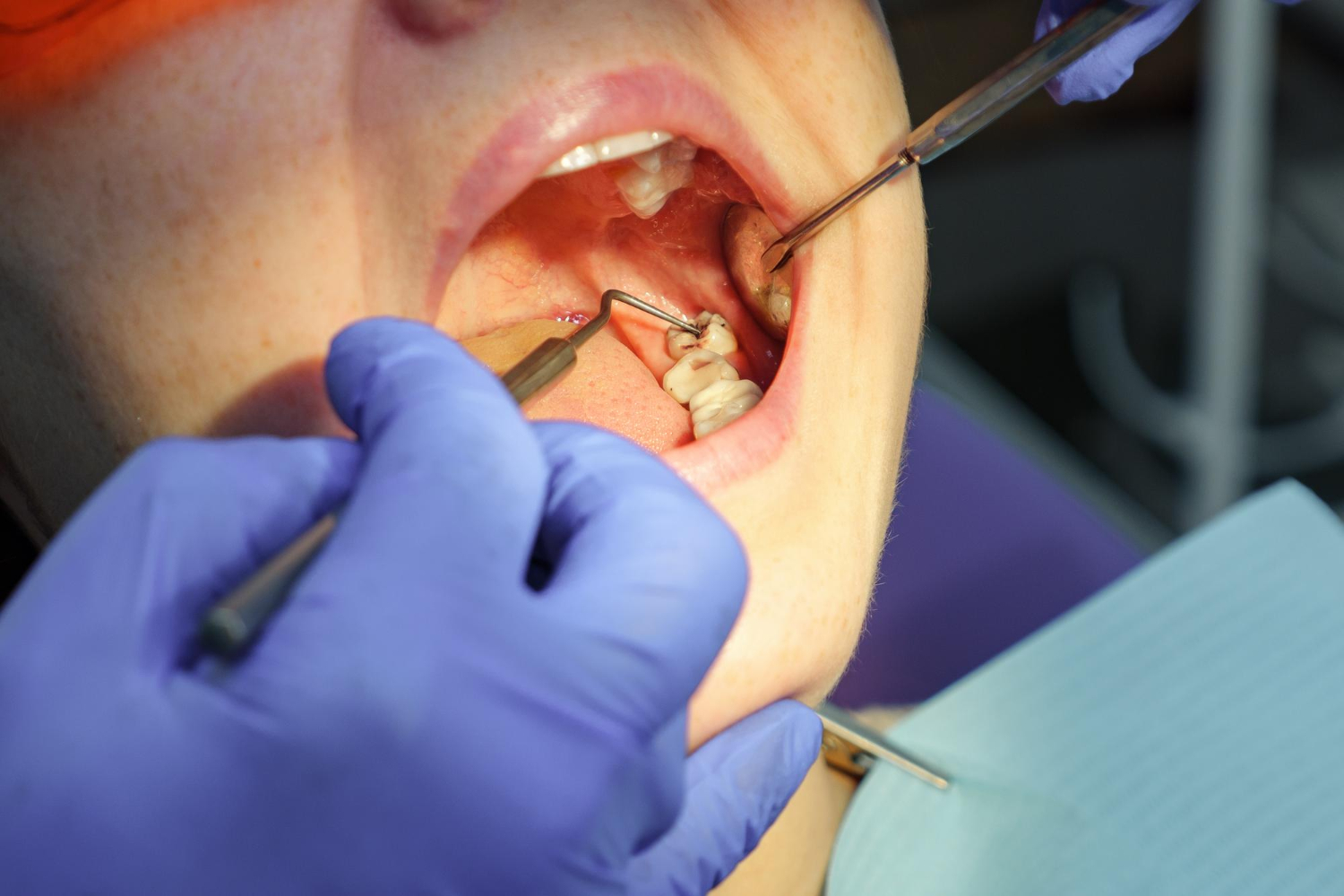 What should I expect during a tooth extraction